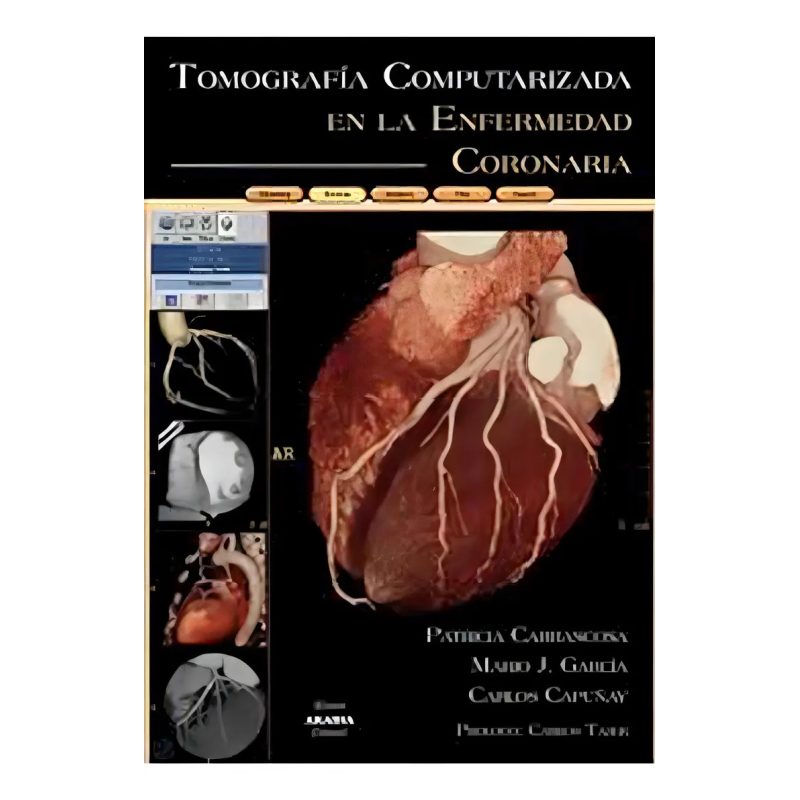 TOMOGRAFIA COMPUTARIZADA EN LA ENFERMEDAD CORONARIA (CARTONE)